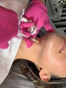 Kybella